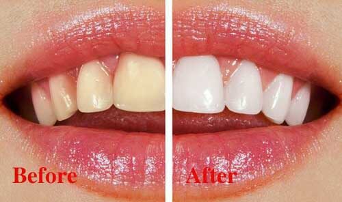 Quy trình tẩy trắng răng Laser Whitening tiêu chuẩn diễn ra thế nào? 1