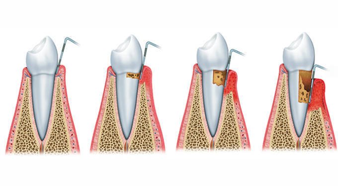 Những giai đoạn phát triển của bệnh viêm nha chu chân răng 2
