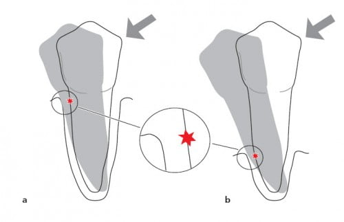 Những giai đoạn phát triển của bệnh viêm nha chu chân răng 3