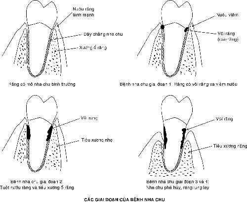 Những giai đoạn phát triển của bệnh viêm nha chu chân răng 1