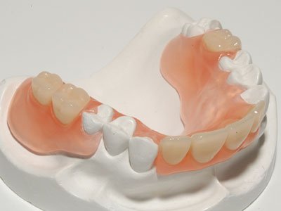 Những ưu và nhược điểm của làm răng giả tháo lắp bạn nên biết 2