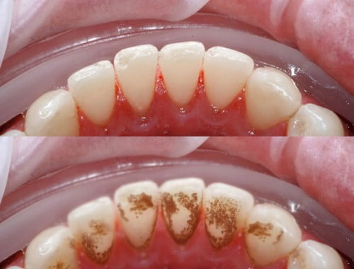 Kết quả hình ảnh cho lấy cao răng