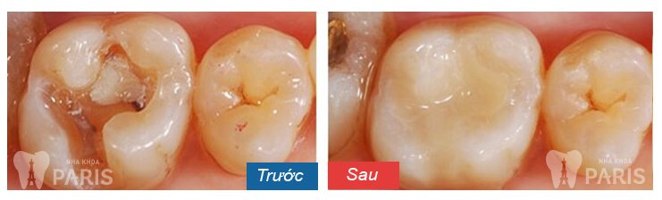 Làm sao để chữa nhức răng an toàn mà đảm bảo hiệu quả? 2