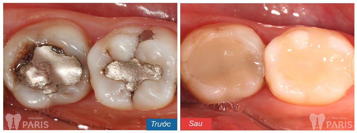 Cách chữa sâu răng bằng gừng và tỏi an toàn và hiệu quả dài lâu 4