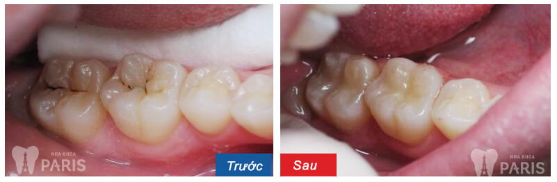 3 cách chữa sâu răng bằng lá ổi hiệu quả "Cấp Tốc" ngay tại nhà 6