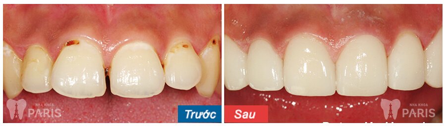 Cách chữa sâu răng bằng gừng và tỏi an toàn và hiệu quả dài lâu 5