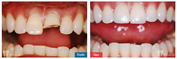 Làm sao để chữa nhức răng an toàn mà đảm bảo hiệu quả? 3