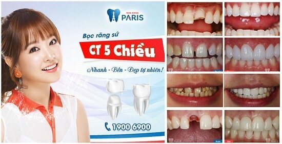 Giới thiệu dịch vụ làm răng tại Paris - nha khoa thẩm mỹ Vinh 3