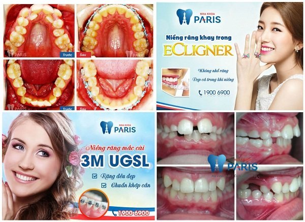 Giới thiệu dịch vụ làm răng tại Paris - nha khoa thẩm mỹ Vinh 7