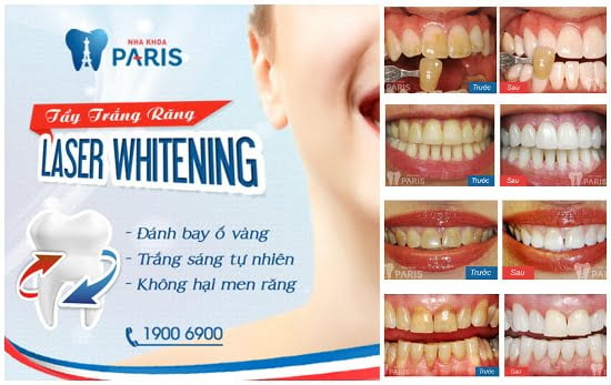 Giới thiệu dịch vụ làm răng tại Paris - nha khoa thẩm mỹ Vinh 5