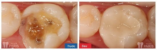 Cách chữa sâu răng bằng lá tía tô có thực sự hiệu quả không? 3