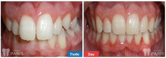 Nhổ răng để niềng có ảnh hưởng gì không, liệu có đau và nguy hiểm? 4