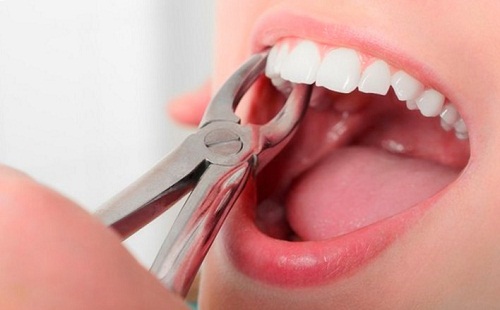 Nhổ răng để niềng có ảnh hưởng gì không, liệu có đau và nguy hiểm? 1