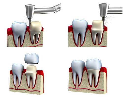 TOP 5 nguyên nhân gây đau buốt răng cửa thường gặp 4