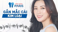 Cận cảnh quá trình niềng răng hô