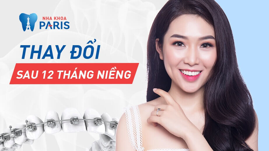 Hotface Thùy Linh - Thay đổi sau 12 tháng niềng