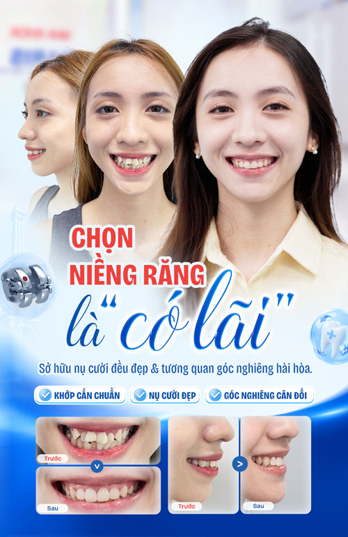 Kết quả niềng răng