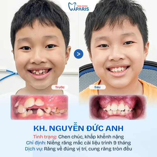 Case niềng răng trẻ em 1