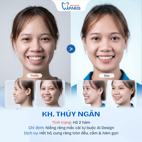 Case niềng răng người trưởng thành 2