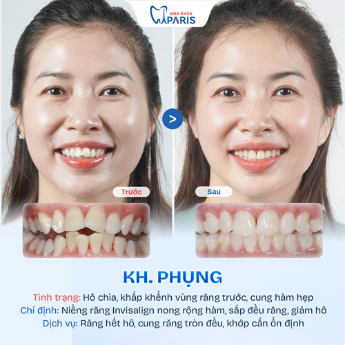 Case niềng răng người trưởng thành 1