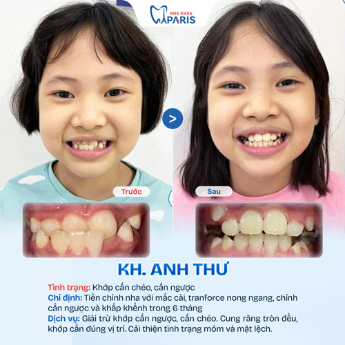 Case niềng răng trẻ em 2