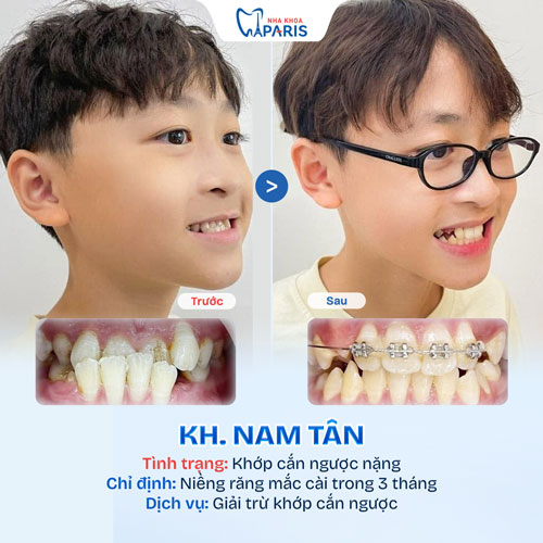 Case niềng răng trẻ em 3