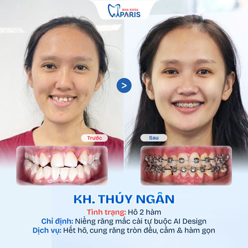Case niềng răng người trưởng thành 4