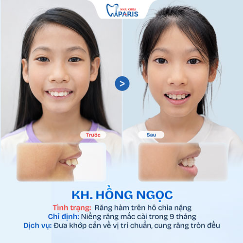 Case niềng răng trẻ em 4