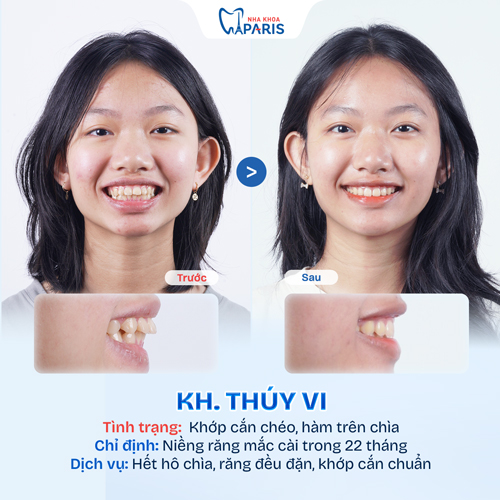 Case niềng răng học sinh sinh viên 1