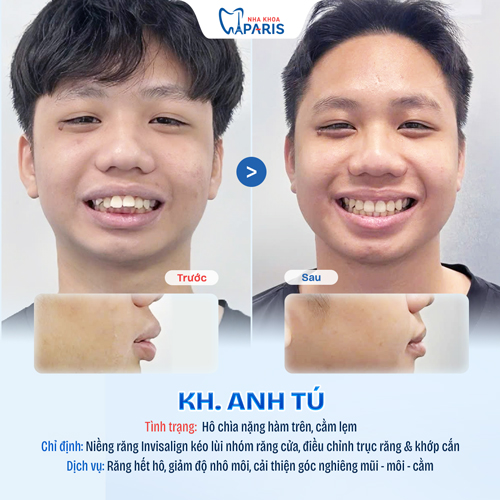 Case niềng răng học sinh sinh viên 2