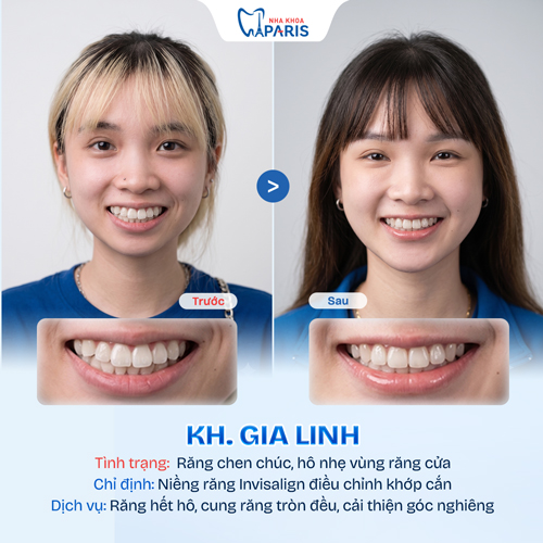 Case niềng răng học sinh sinh viên 3