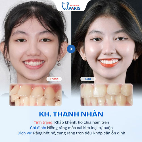 Case niềng răng người trưởng thành 3