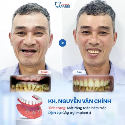 Case 01 mất răng toàn hàm