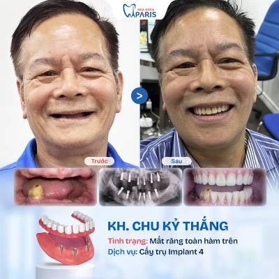 Case 02 mất răng toàn hàm