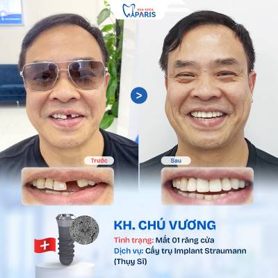 Case 03 mất 1 răng