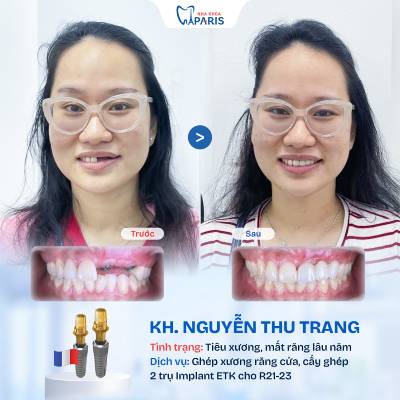 Case 04 mất 1 răng