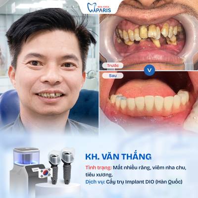 Case 01 mất nhiều răng