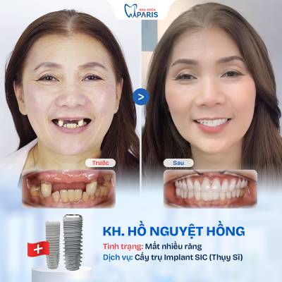 Case 02 mất nhiều răng