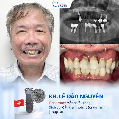 Case 03 mất nhiều răng