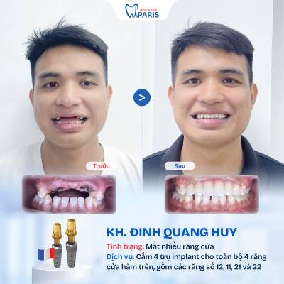Case 04 mất nhiều răng