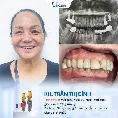 Case 05 mất nhiều răng