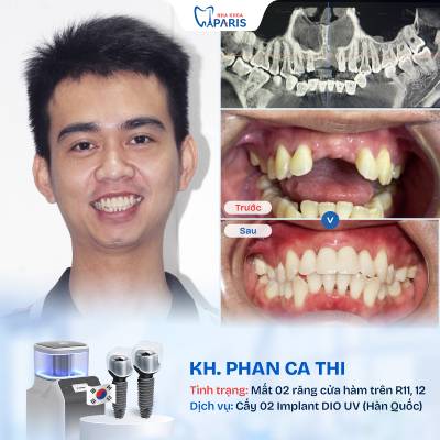 Case 06 mất nhiều răng