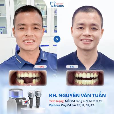 Case 07 mất nhiều răng