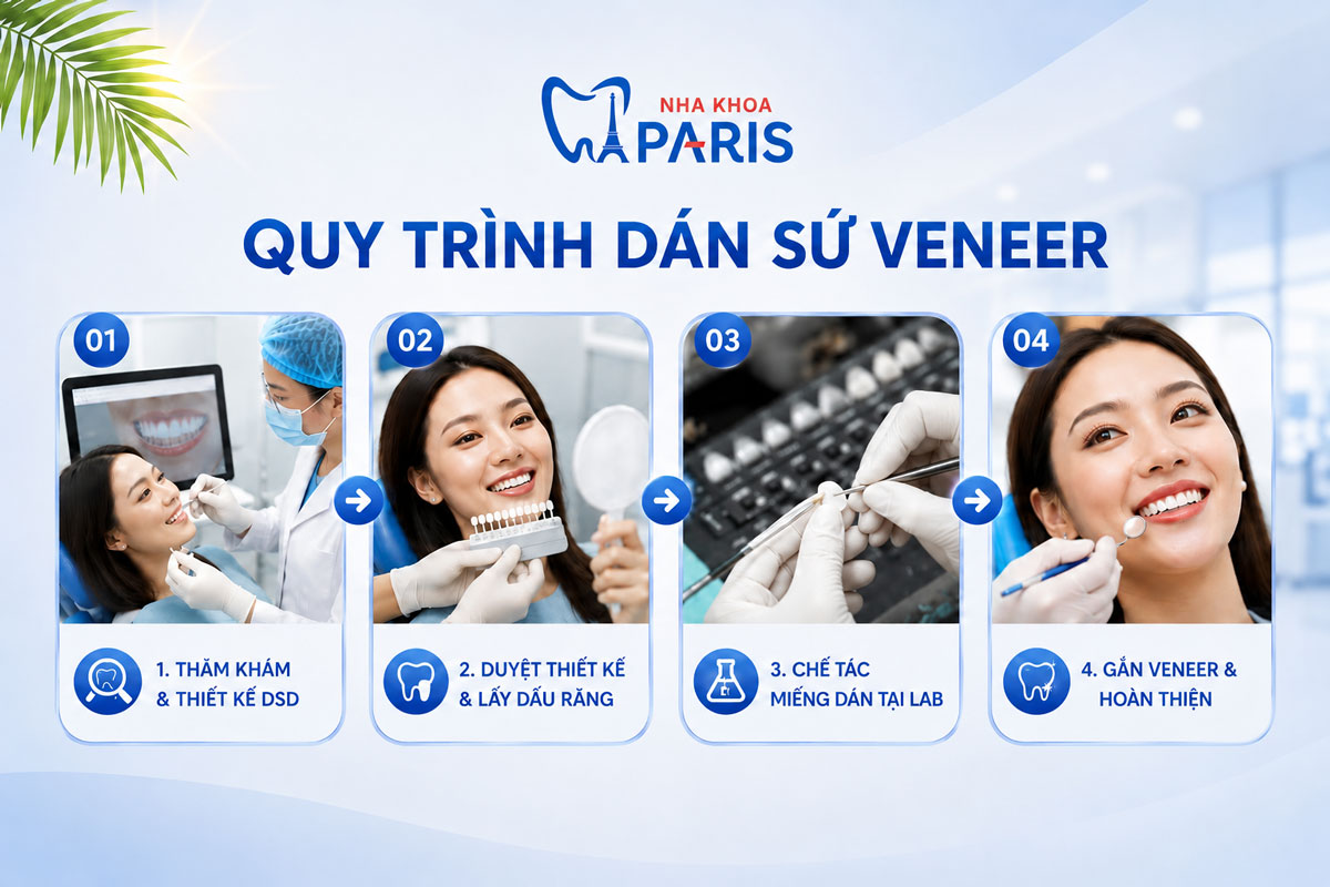 Quy trình dán sứ Veneer tại Nha Khoa Paris