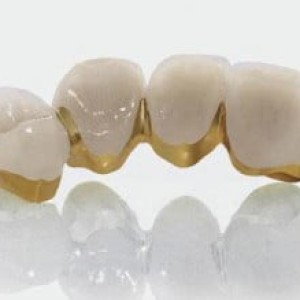 Có những loại răng sứ nào?