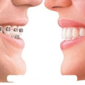 Niềng răng cho người trưởng thành có nhổ răng hay không?