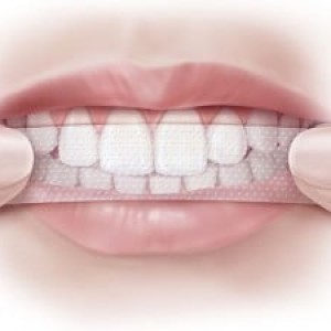 Miếng dán tẩy trắng răng có thực sự an toàn không?