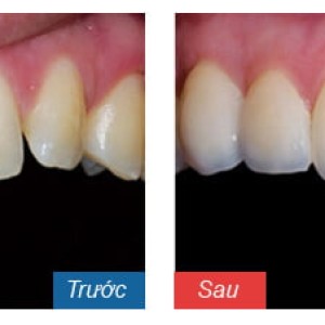 Trước – sau lắp cầu răng