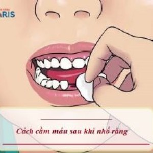 Cách cầm máu sau khi nhổ răng Tại Nhà hiệu quả chỉ sau 10 phút