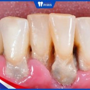 Vôi răng dưới Nướu: Nguyên nhân & Cách điều trị dứt điểm